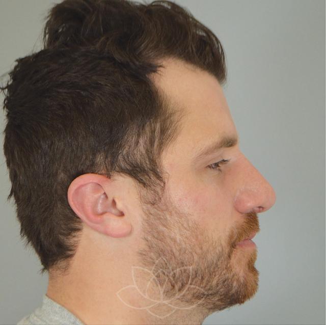 Functional Rhinoplasty after at Jordan L. Wallin, MD in St. George, UT