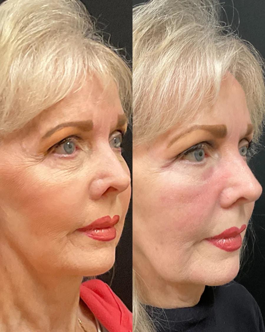 Atlanta Oculofacial Plastic Surgery (Sahitya Reddy, MD) laser treatment result — Sandy Springs, GA