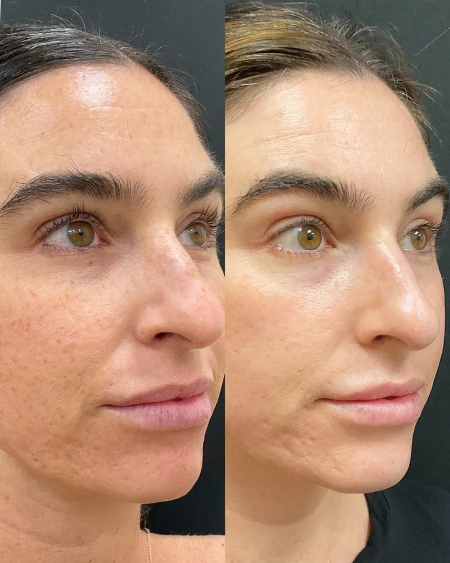 Atlanta Oculofacial Plastic Surgery (Sahitya Reddy, MD) laser treatment result — Sandy Springs, GA