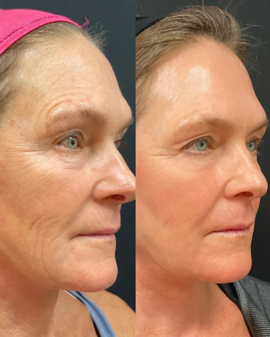 Atlanta Oculofacial Plastic Surgery (Sahitya Reddy, MD) laser treatment result — Sandy Springs, GA