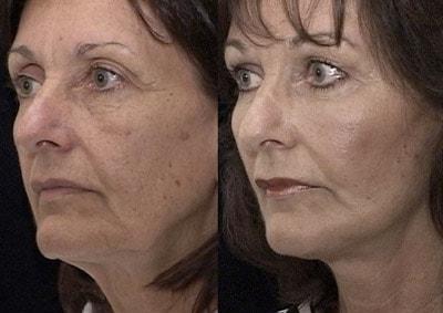 Mark Berman, MD fat transfer result — Beverly Hills, CA
