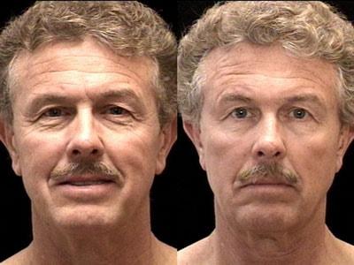 Mark Berman, MD fat transfer result — Beverly Hills, CA