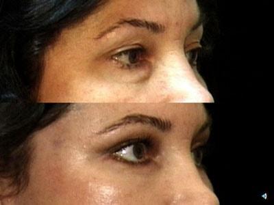 Mark Berman, MD fat transfer result — Beverly Hills, CA