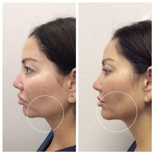 Chin Implant after at Flawless MedSpa in Las Vegas, NV