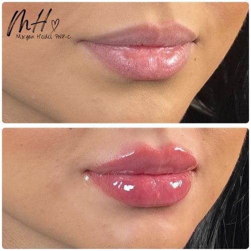 Lip Filler after at Flawless MedSpa in Las Vegas, NV