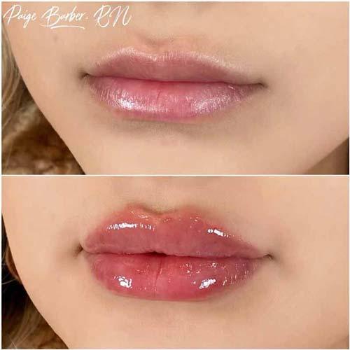 Lip Filler result at Flawless MedSpa in Las Vegas, NV