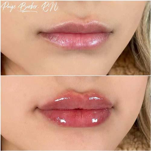 Flawless MedSpa lip filler result — Las Vegas, NV