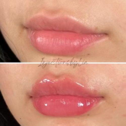 Lip Filler result at Flawless MedSpa in Las Vegas, NV