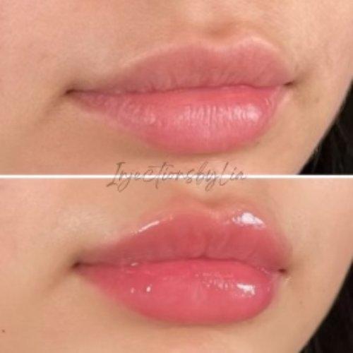 Lip Filler result at Flawless MedSpa in Las Vegas, NV