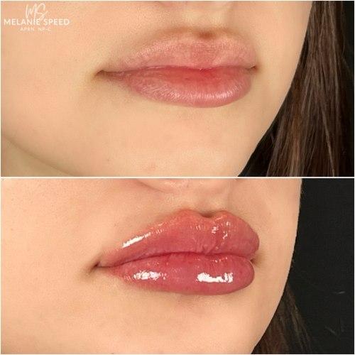 Lip Filler before at Flawless MedSpa in Las Vegas, NV
