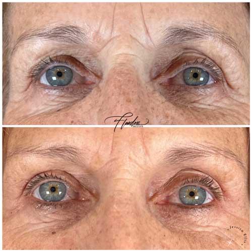 Flawless MedSpa botox result — Las Vegas, NV