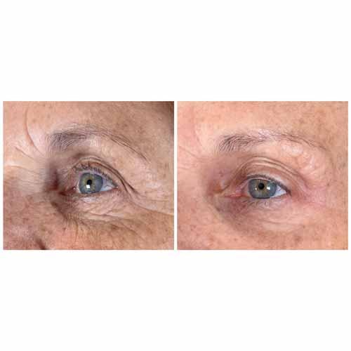 Flawless MedSpa botox result — Las Vegas, NV