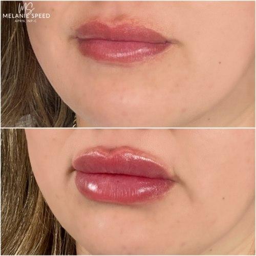 Lip Filler before at Flawless MedSpa in Las Vegas, NV
