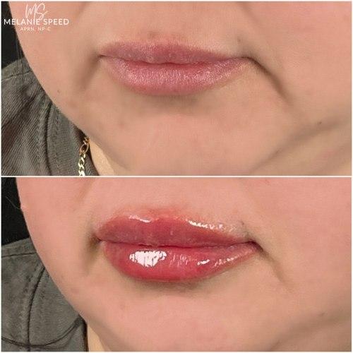 Lip Filler after at Flawless MedSpa in Las Vegas, NV