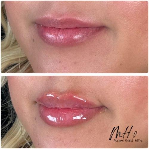 Lip Filler after at Flawless MedSpa in Las Vegas, NV