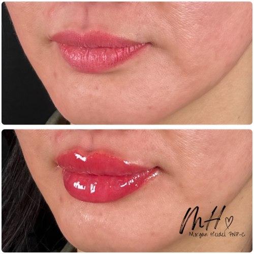 Lip Filler before at Flawless MedSpa in Las Vegas, NV