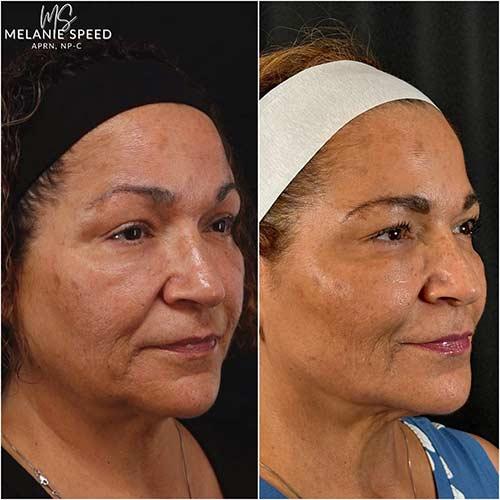 Chin Implant after at Flawless MedSpa in Las Vegas, NV