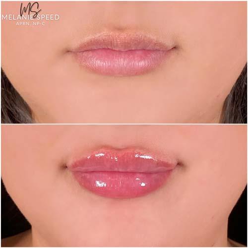 Lip Filler result at Flawless MedSpa in Las Vegas, NV