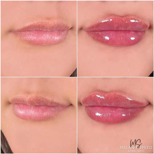 Lip Filler result at Flawless MedSpa in Las Vegas, NV