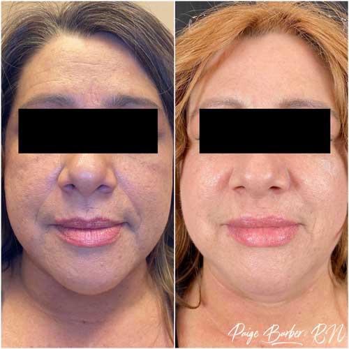 Chin Implant after at Flawless MedSpa in Las Vegas, NV