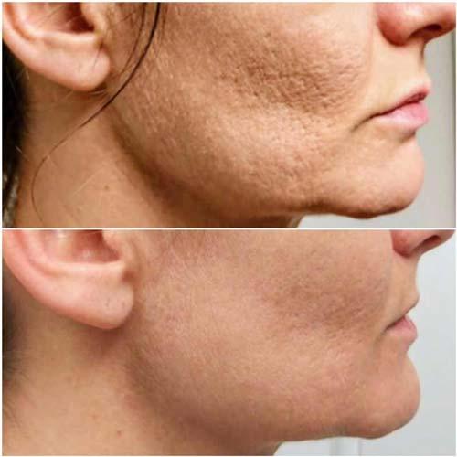 Chin Implant before at Flawless MedSpa in Las Vegas, NV