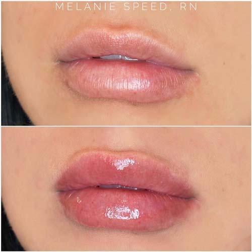 Lip Filler result at Flawless MedSpa in Las Vegas, NV