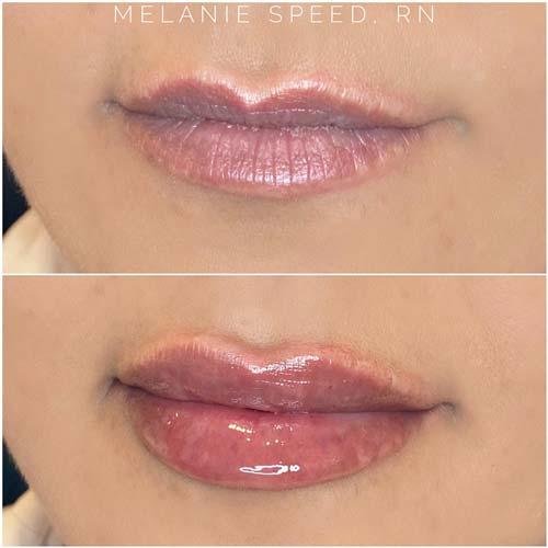 Lip Filler result at Flawless MedSpa in Las Vegas, NV
