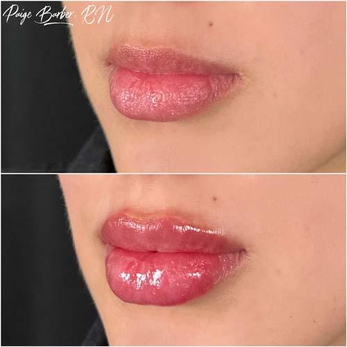 Lip Filler result at Flawless MedSpa in Las Vegas, NV