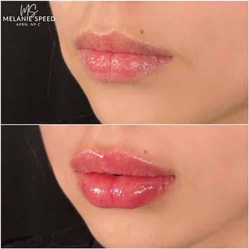 Lip Filler result at Flawless MedSpa in Las Vegas, NV