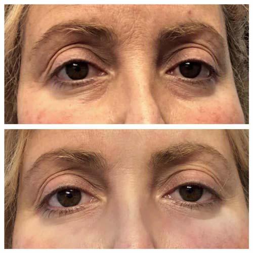 Dermal Fillers before at Flawless MedSpa in Las Vegas, NV