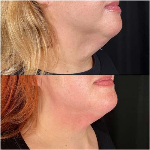 Chin Implant after at Flawless MedSpa in Las Vegas, NV