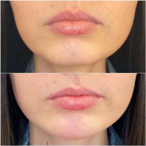 Chin Implant after at Flawless MedSpa in Las Vegas, NV