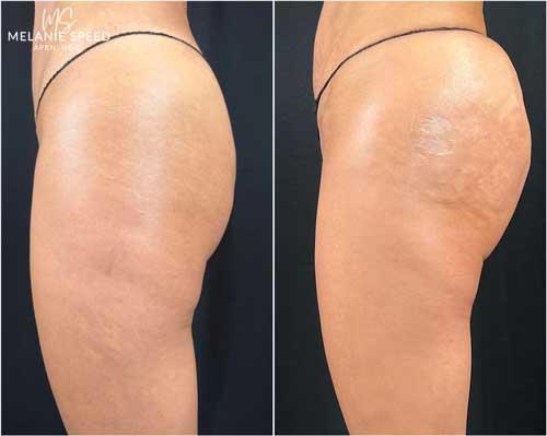 Flawless MedSpa bbl result — Las Vegas, NV