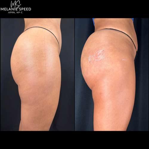 Flawless MedSpa bbl result — Las Vegas, NV