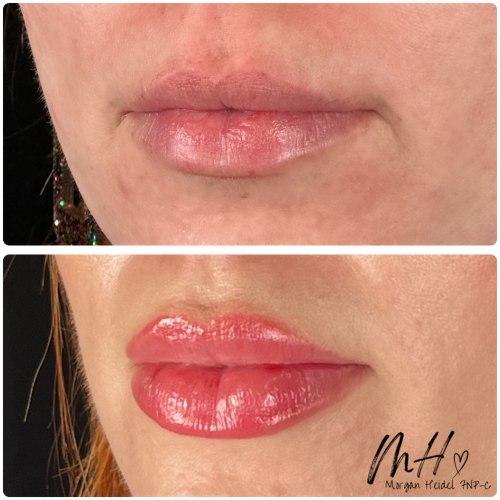 Lip Filler after at Flawless MedSpa in Las Vegas, NV