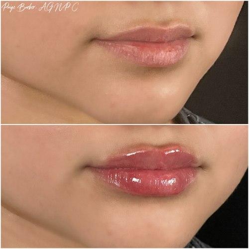 Lip Filler before at Flawless MedSpa in Las Vegas, NV
