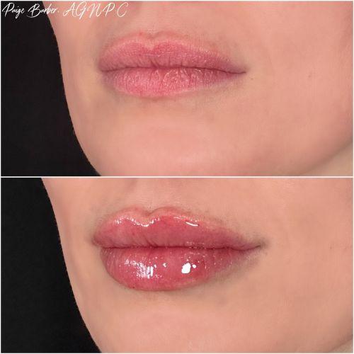 Lip Filler before at Flawless MedSpa in Las Vegas, NV