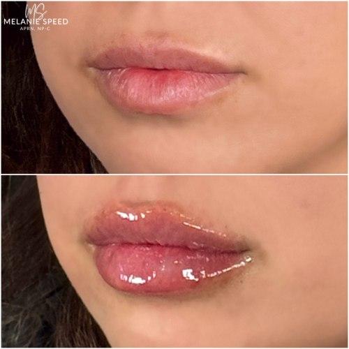 Flawless MedSpa lip filler after — Las Vegas, NV