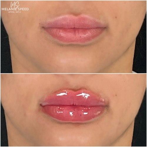 Lip Filler before at Flawless MedSpa in Las Vegas, NV