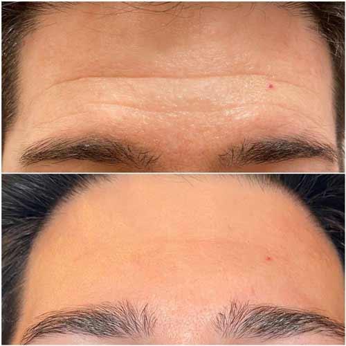 Flawless MedSpa botox after — Las Vegas, NV