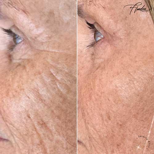Flawless MedSpa after — Las Vegas, NV
