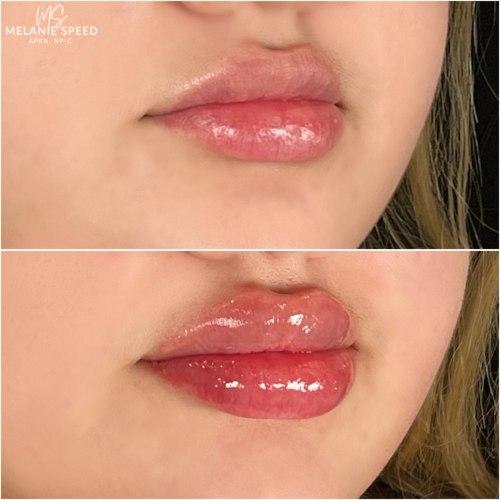 Lip Filler after at Flawless MedSpa in Las Vegas, NV