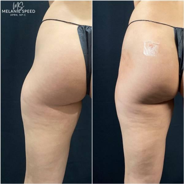 Brazilian Butt Lift after at Flawless MedSpa in Las Vegas, NV