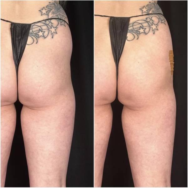 Brazilian Butt Lift before at Flawless MedSpa in Las Vegas, NV