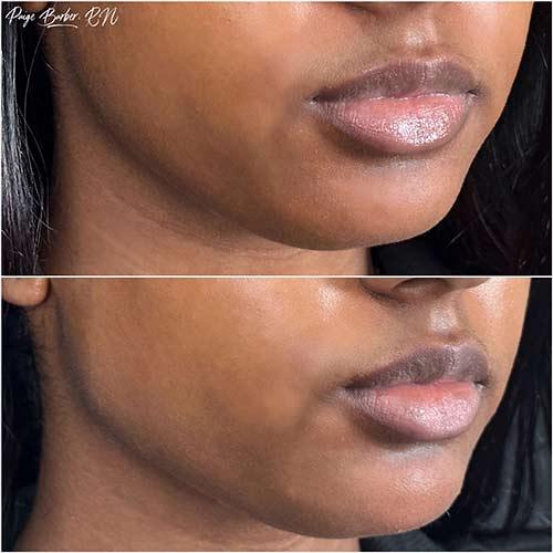 Chin Implant after at Flawless MedSpa in Las Vegas, NV