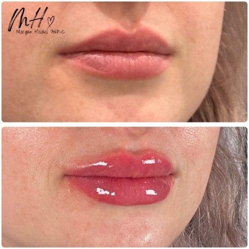 Lip Filler after at Flawless MedSpa in Las Vegas, NV