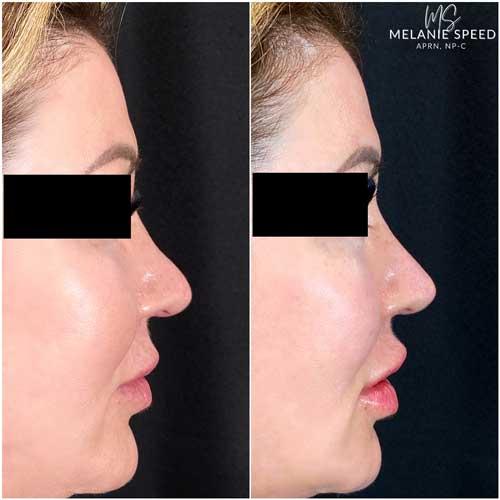 Rhinoplasty after at Flawless MedSpa in Las Vegas, NV