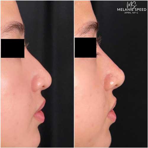 Rhinoplasty before at Flawless MedSpa in Las Vegas, NV