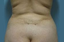 Vladimir Grigoryants, MD liposuction after — Glendale, CA