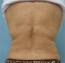 Vladimir Grigoryants, MD liposuction after — Glendale, CA